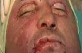 Türkiye'de ilk kez yüz nakli ameliyatı yapıldı